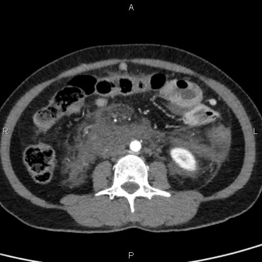 Bilateral adrenal gland hyperenhancement in pancreatitis (Radiopaedia 86642-102753 B 77).jpg