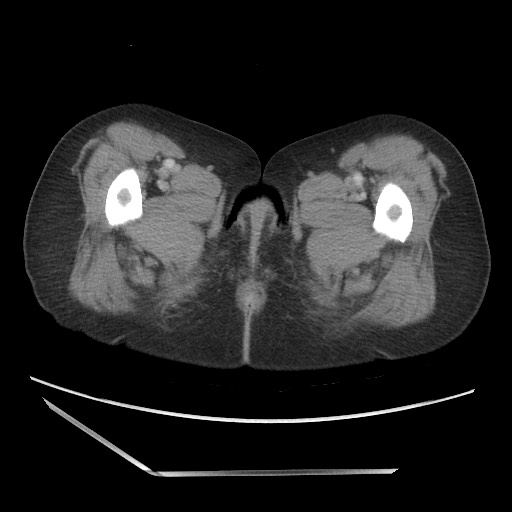 Bilateral adrenal granulocytic sarcomas (chloromas) (Radiopaedia 78375-91007 A 136).jpg