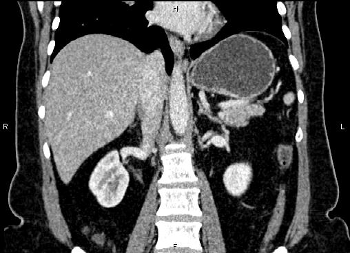 Bilateral benign adrenal adenomas (Radiopaedia 86912-103124 D 35).jpg