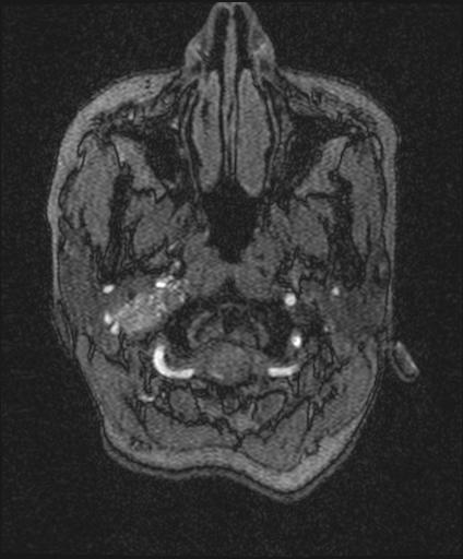 Bilateral carotid body tumors and right glomus jugulare tumor (Radiopaedia 20024-20060 Axial MRA 2).jpg
