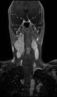 File:Bilateral carotid body tumors and right glomus jugulare tumor (Radiopaedia 20024-20060 MRA 28).jpg