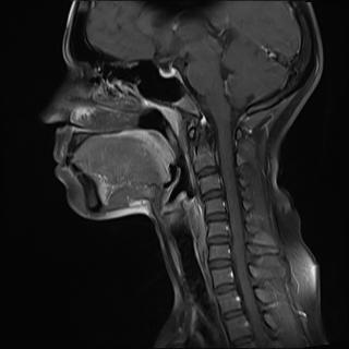 File:Bilateral carotid body tumors and right jugular paraganglioma (Radiopaedia 20024-20060 Sagittal 8).jpg