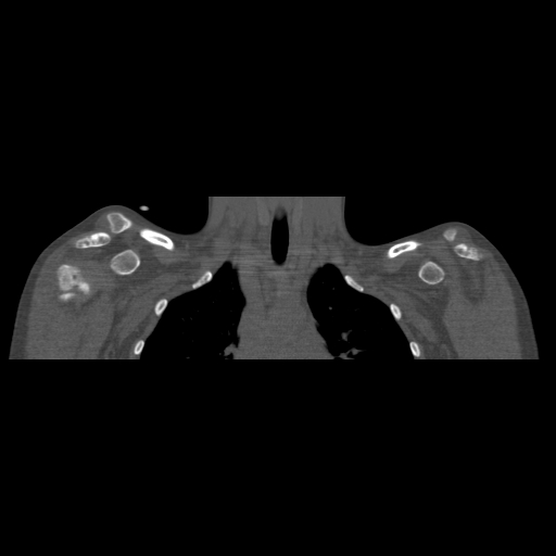 File:Bilateral chronic posterior shoulder dislocation (Radiopaedia 39213-41452 Coronal bone window 19).jpg
