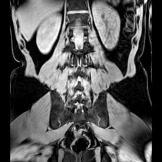 Bilateral conjoined nerve roots at different levels (Radiopaedia 73312-84063 Coronal WE 38).jpg