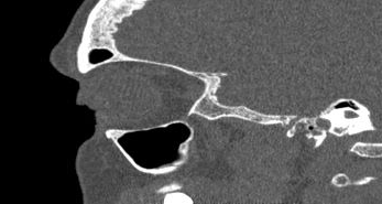 File:Bilateral ectopic infraorbital nerves (Radiopaedia 49006-54084 Sagittal 31).png