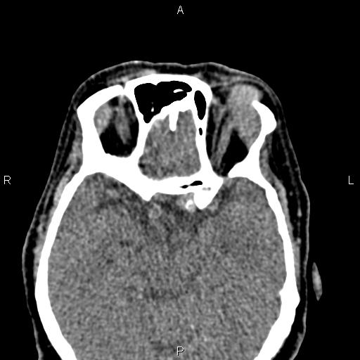 Bilateral enlargement of lacrimal glands - sarcoidosis (Radiopaedia 62627-70921 Axial non-contrast 59).jpg