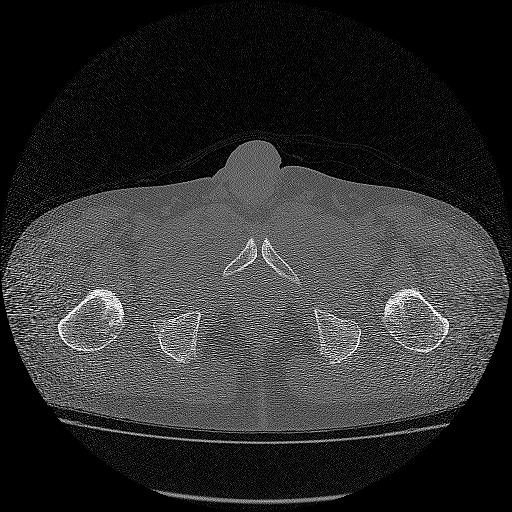 Bilateral femoral neck stress fractures (Radiopaedia 28666-28954 Axial bone window 74).png