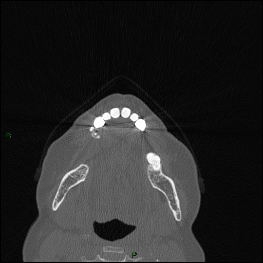 File:Bilateral frontal mucoceles (Radiopaedia 82352-96454 Axial bone window 287).jpg