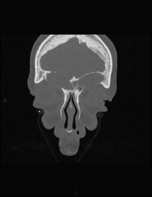 Bilateral frontal mucoceles (Radiopaedia 82352-96454 Coronal 70).jpg