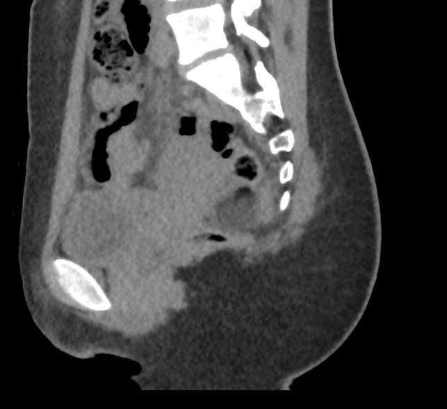 Bilateral mature cystic ovarian teratoma (Radiopaedia 88821-105592 D 26).jpg
