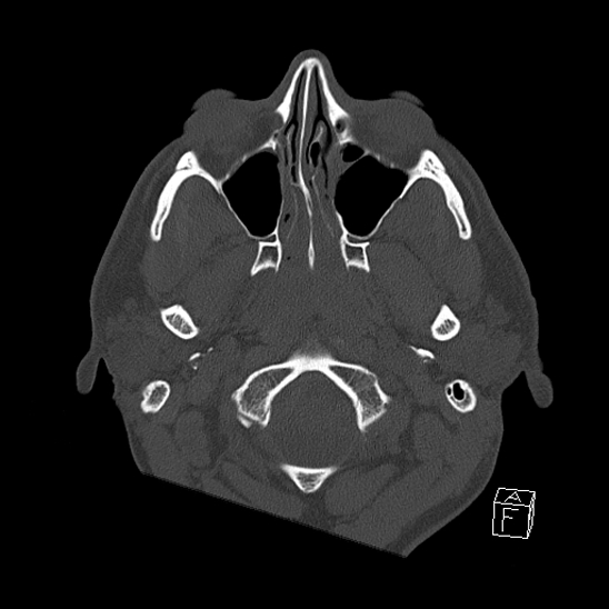 Bilateral occipital condyle fracture (type 2) (Radiopaedia 87675-104089 Axial bone window 10).jpg