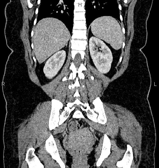 Bilateral ovarian dermoid cysts (Radiopaedia 85785-101603 C 44).jpg
