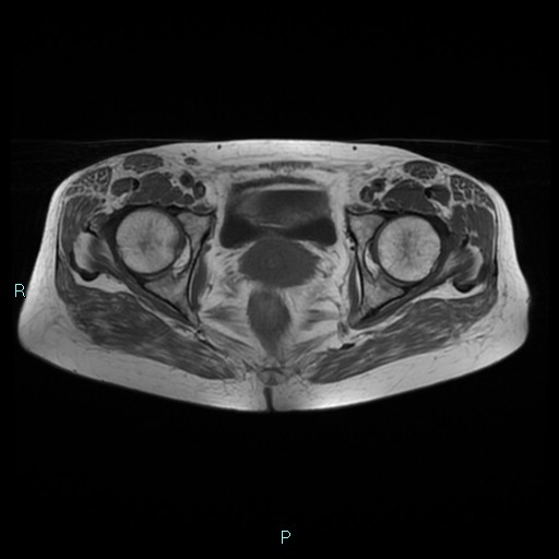 File:Bilateral ovarian fibroma (Radiopaedia 44568-48293 Axial T1 21).jpg