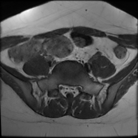 File:Bilateral ovarian fibrothecomas - adolescent (Radiopaedia 86604-102707 Axial T1 5).jpg