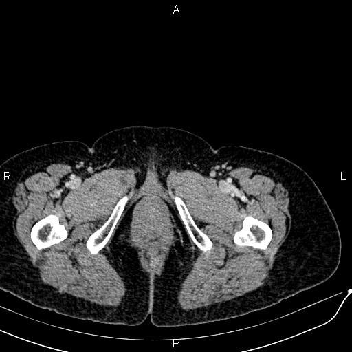 Bilateral ovarian serous cystadenocarcinoma (Radiopaedia 86062-101989 B 110).jpg