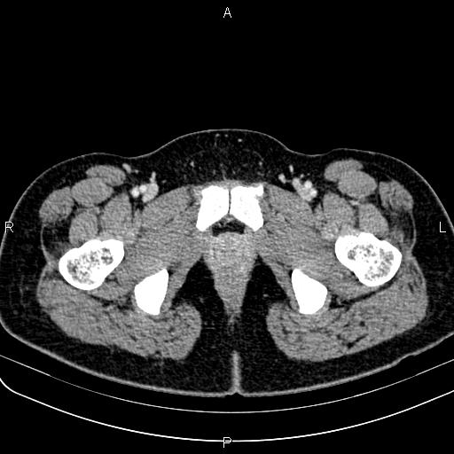 Bilateral ovarian teratoma (Radiopaedia 83131-97503 Axial With contrast 82).jpg