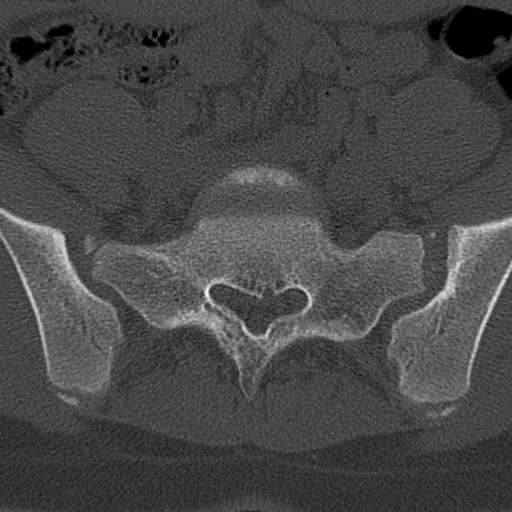 Bilateral pars defect (Radiopaedia 26691-26846 Axial bone window 77).jpg