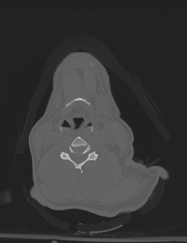 Bilateral perched facet joint (Radiopaedia 63149-71669 Axial bone window 32).jpg
