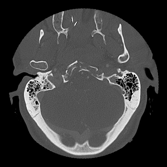 File:Bilateral perched facets with cord injury (Radiopaedia 45587-49713 Axial bone window 13).jpg