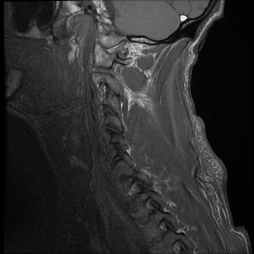 File:Bilateral perched facets with cord injury (Radiopaedia 45587-49714 Sagittal T1 2).jpg