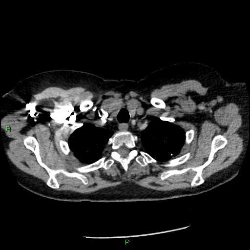 Bilateral pulmonary emboli (Radiopaedia 32700-33669 Axial C+ CTPA 10).jpg