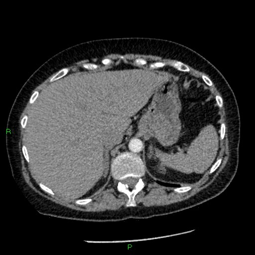 Bilateral pulmonary emboli (Radiopaedia 32700-33669 Axial C+ CTPA 100).jpg