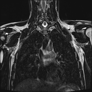 File:Bilateral spinoglenoid notch ganglion cysts (Radiopaedia 29577-30082 Coronal T2 65).jpg