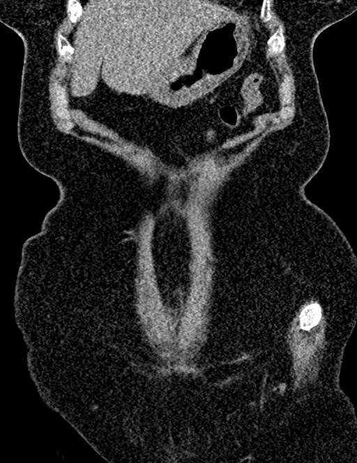 Bilateral staghorn calculi (Radiopaedia 59475-66842 Coronal non-contrast 38).jpg