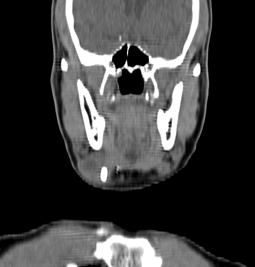 Bilateral submandibular sialolithiasis with sialadenitis (Radiopaedia 70721-80881 Coronal non-contrast 16).jpg