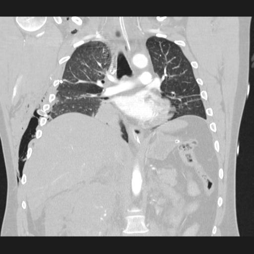 Bilateral traumatic renovascular injury (Radiopaedia 32051-32995 Coronal lung window 44).jpg