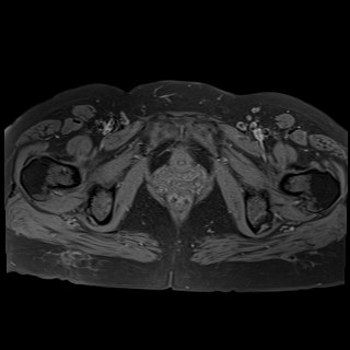 Bilateral tubo-ovarian abscesses (Radiopaedia 58635-65829 Axial T1 fat sat 39).jpg
