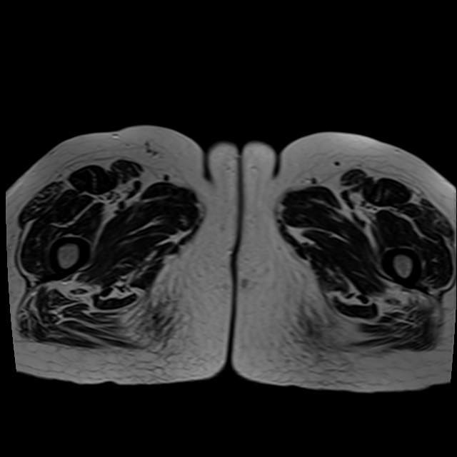 Bilateral tubo-ovarian abscesses (Radiopaedia 58635-65829 Axial T2 54).jpg