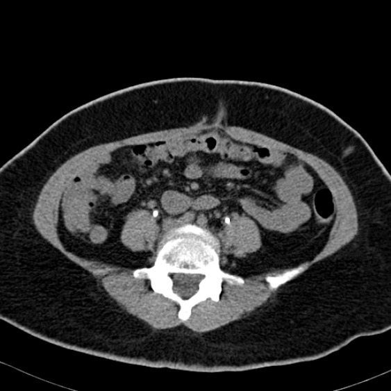 Bilateral ureteric stents (Radiopaedia 48795-53825 Axial non-contrast 38).jpg