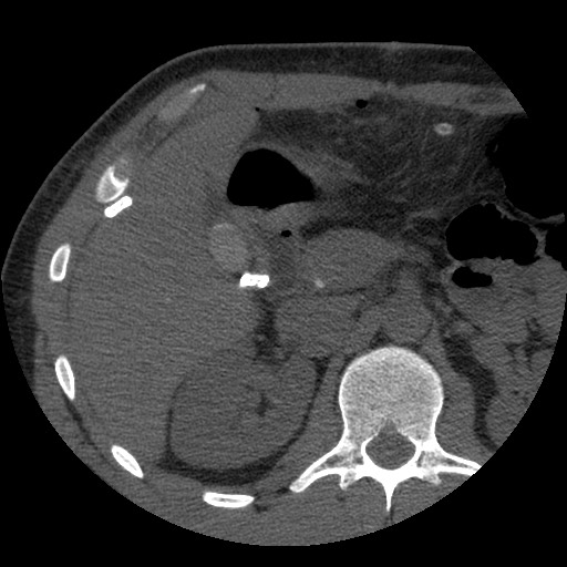 Bile leak from liver traumatic laceration (Radiopaedia 63463-72077 Axial Biliscopin 50).jpg