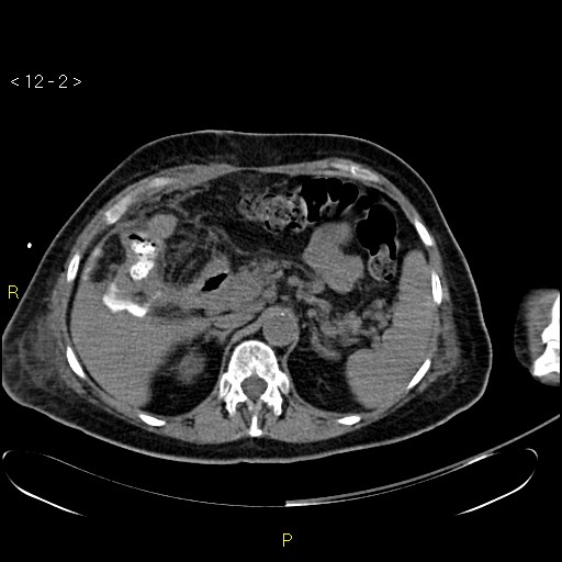 File:Biloma with drainage into the colon (Radiopaedia 20032-20068 B 11).jpg