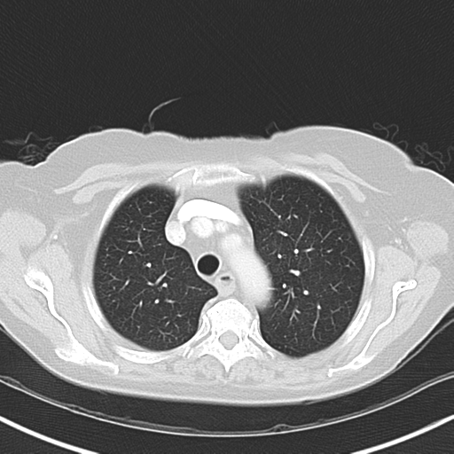 Bladder and bowel cancers (Radiopaedia 37688-39592 Axial lung window 13).png