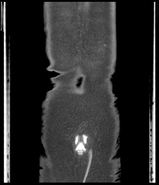 Bladder rupture post renal biopsy (Radiopaedia 30863-31572 Coronal non-contrast 55).jpg