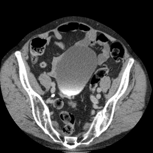 Bladder tumor detected on trauma CT (Radiopaedia 51809-57609 C 108).jpg