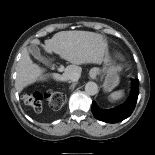 Bladder tumor detected on trauma CT (Radiopaedia 51809-57609 C 32).jpg