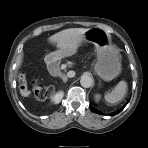 Bladder tumor detected on trauma CT (Radiopaedia 51809-57609 C 38).jpg