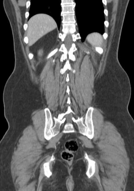 Bleeding duodenal ulcer and adenomyomatosis of gallbladder (Radiopaedia 61834-69861 B 17).jpg