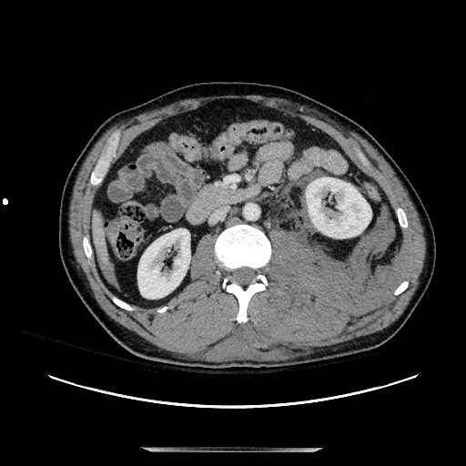 Blunt abdominal trauma with solid organ and musculoskelatal injury with active extravasation (Radiopaedia 68364-77895 A 65).jpg