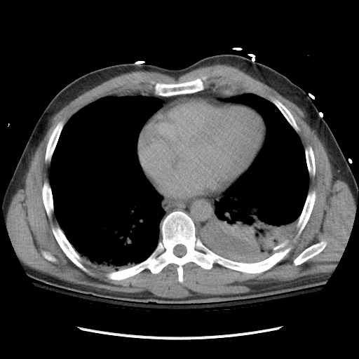 Blunt abdominal trauma with solid organ and musculoskelatal injury with active extravasation (Radiopaedia 68364-77895 Axial C+ delayed 6).jpg