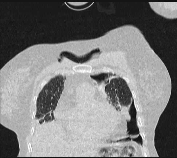 Boerhaave syndrome (Radiopaedia 45644-49799 Coronal lung window 17).jpg