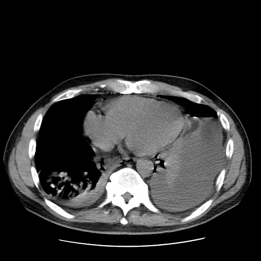 Boerhaave syndrome (Radiopaedia 59796-67310 Axial liver window 44).jpg