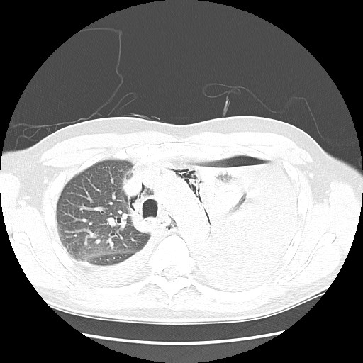 Boerhaave syndrome (Radiopaedia 59796-67310 Axial lung window 22).jpg