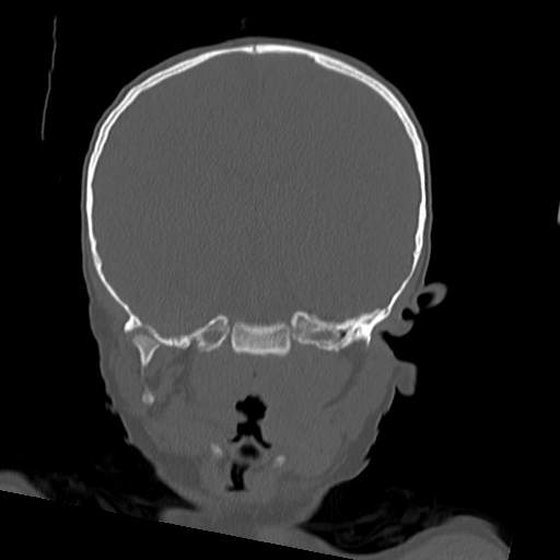 File:Bony atresia of the right external auditory canal (Radiopaedia 27916-28156 Coronal bone window 15).jpg