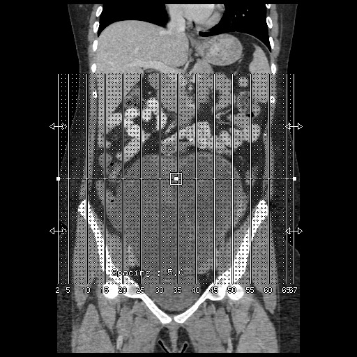 File:Borderline mucinous tumor (ovary) (Radiopaedia 78228-90808 B 1).jpg