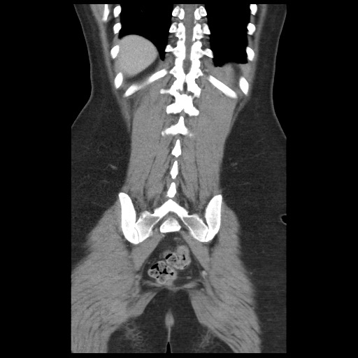 Borderline mucinous tumor (ovary) (Radiopaedia 78228-90808 C 41).jpg