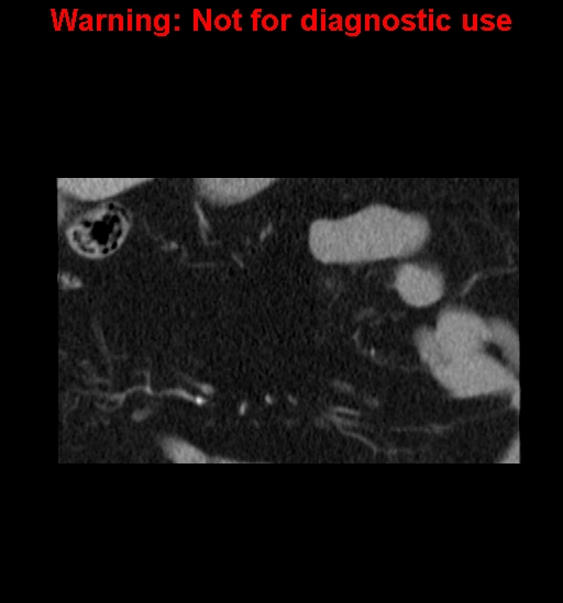 File:Bosniak renal cyst - type IV (Radiopaedia 23402-23466 C 8).jpg